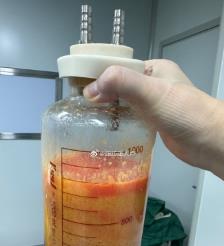 和田水动力吸脂手术要做多久？